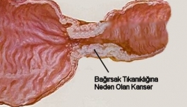 Barsak Kanseri