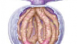 Glomerülonefrit