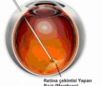 Argon Laser Fakik Vitrektomi
