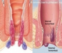 Arteriyovenöz Malformasyon