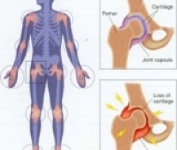 Artritin En Genel Türleri Hangileridir?