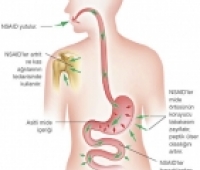 Artritin Tedavisinde Kortizonun Rolü Nedir?